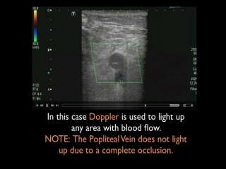 5 ultrasound deep vein thrombosis