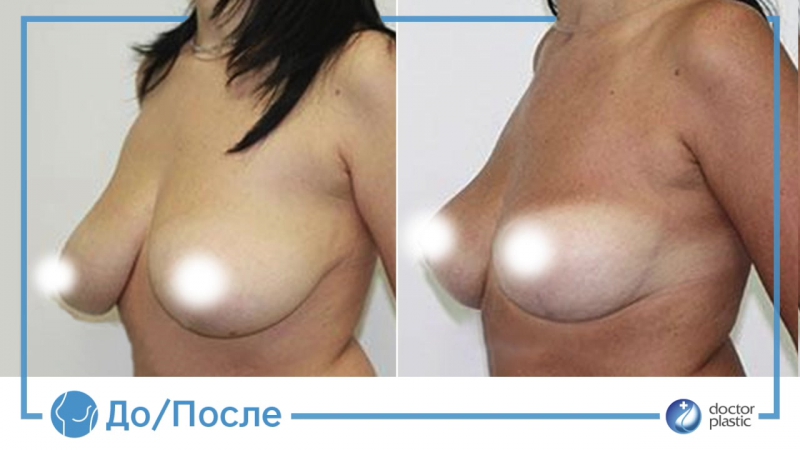 До и после редукционная маммопластика в клинике doctor plastic