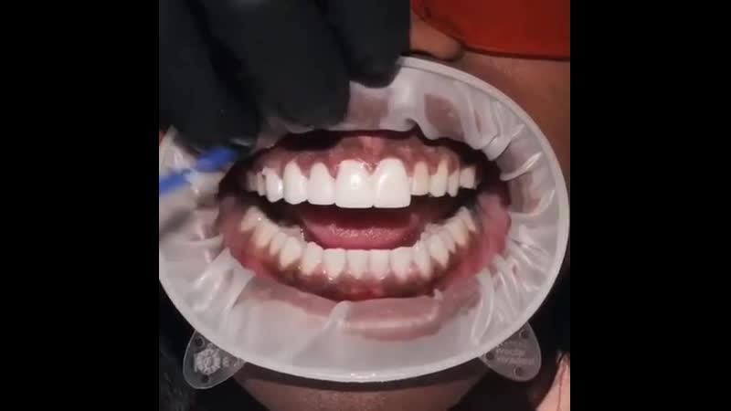 Виниры – несъемная ортопедическая конструкция