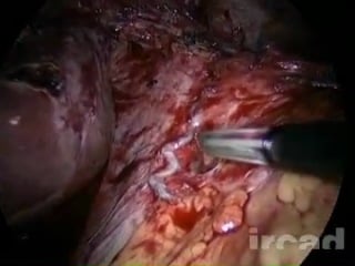 Laparoscopic redo for dysphagia after nissen fundoplication induced by fibrosis at the hiatal orifice laparoscopic surgery on