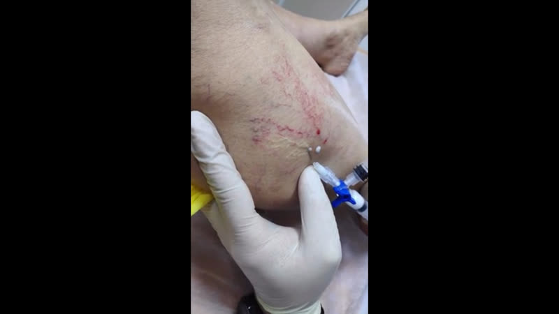 Склеротерапия