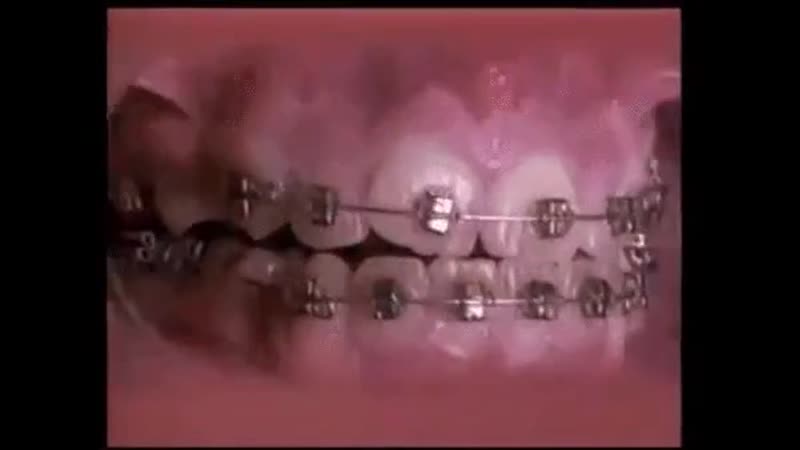Брекеты в действии