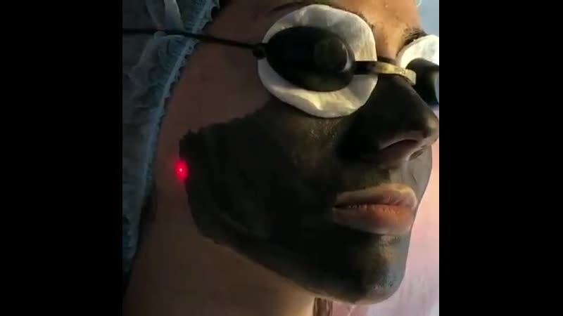 Карбоновый пилинг для омоложения круглый год