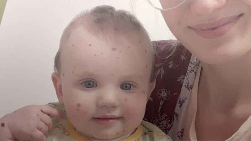 на щеке пятно родимое а на висках