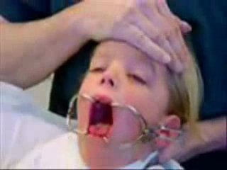 Тонзиллэктомия по методу слудера