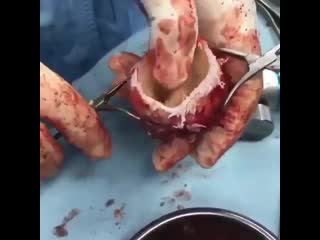 Хирургическая замена тазобедренного сустава с помощью искусственного протеза