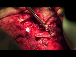 31 трепанация черепа удаление опухоли головного мозга