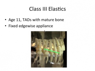 Orthodontic treatment pt 2 ортодонтия