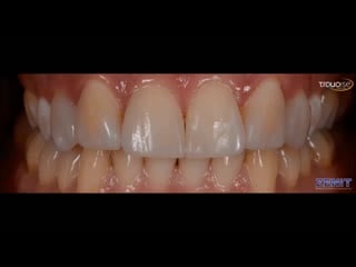 Zenit nano ceramic composite (president dental study club)