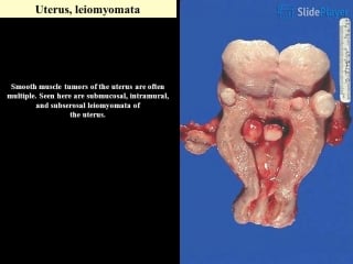 Leiomyomas uteri markedly distorted uterine corpus with multiple irregular masses protruding from its surface