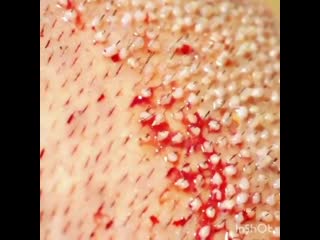 Пересадка волос