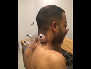Chinese cupping therapy