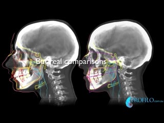 Erin has jaw surgery watch video end first before after jaw surgery correction dental overbite ортодонтия