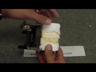 Bruxism splint part 1 case overview