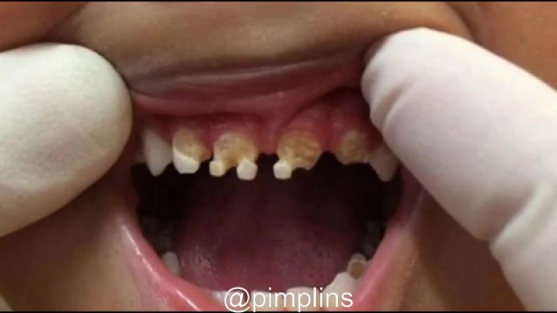 Дантисты продемонстрировали жуткие последствия потребления колы