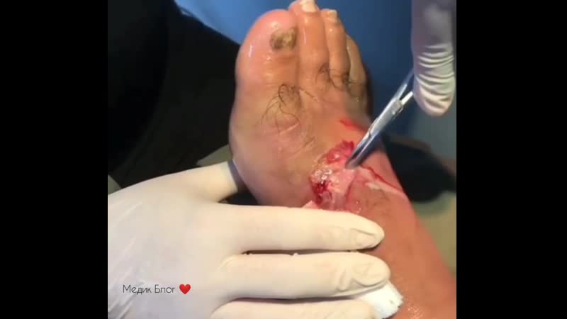 2 3 дренаж абсцесса с помощью скальпеля и корцанга