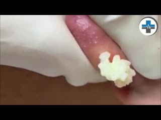 Киста на мочке уха