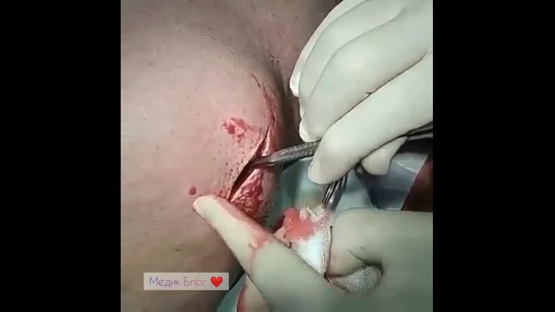 Вскрытие абсцесса после неправильных внутримышечных инъекций в домашних условиях