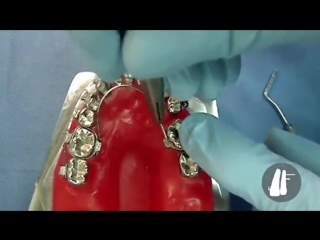 Lingual arch activated in geometry ортодонтия