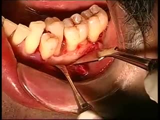 Periodontal surgery with endogain and bone ceratic