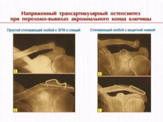 Остеосинтез с применением фиксаторов с памятью формы при переломах и несращениях ключицы