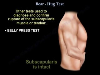 Subscapularis tendon tear,bear hug test, everything you need to know dr n