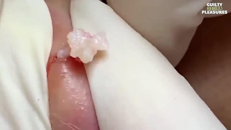 Кисты porn video – Выдавливание кисты на ухе