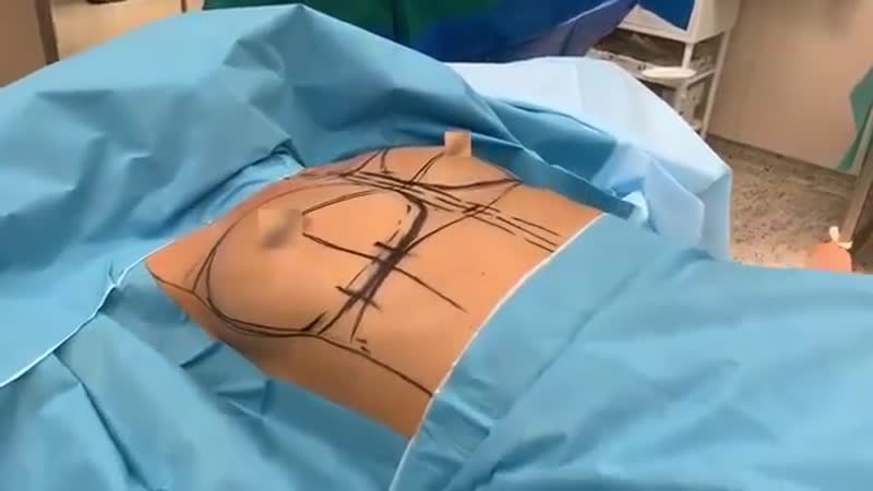 После операции грудь пациентки идеальна с любого ракурса! ⠀ как вам результат увеличивающей маммопластики? оценивайте от 1 до 10