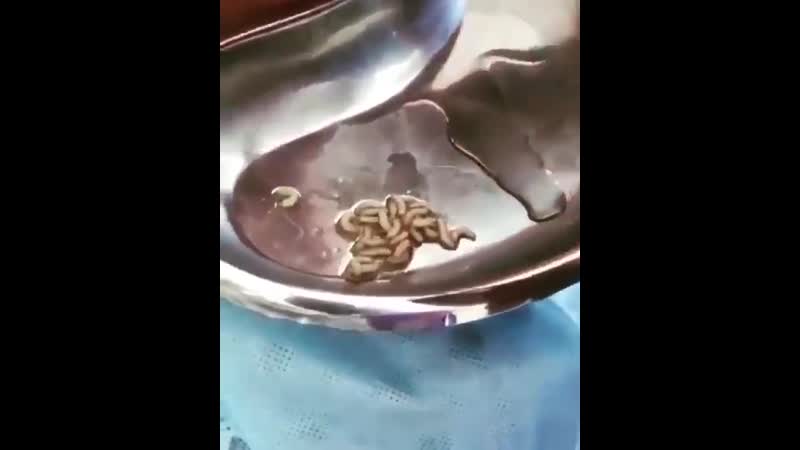 Доктор удаляет десятки извивающихся живых личинок из уха мальчика!