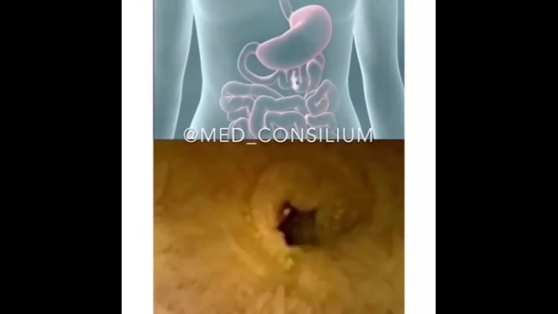 Капсульная эндоскопия это методика осмотра кишечника (тонкой и толстой кишки) на всем его протяжении при помощи видеокапсулы