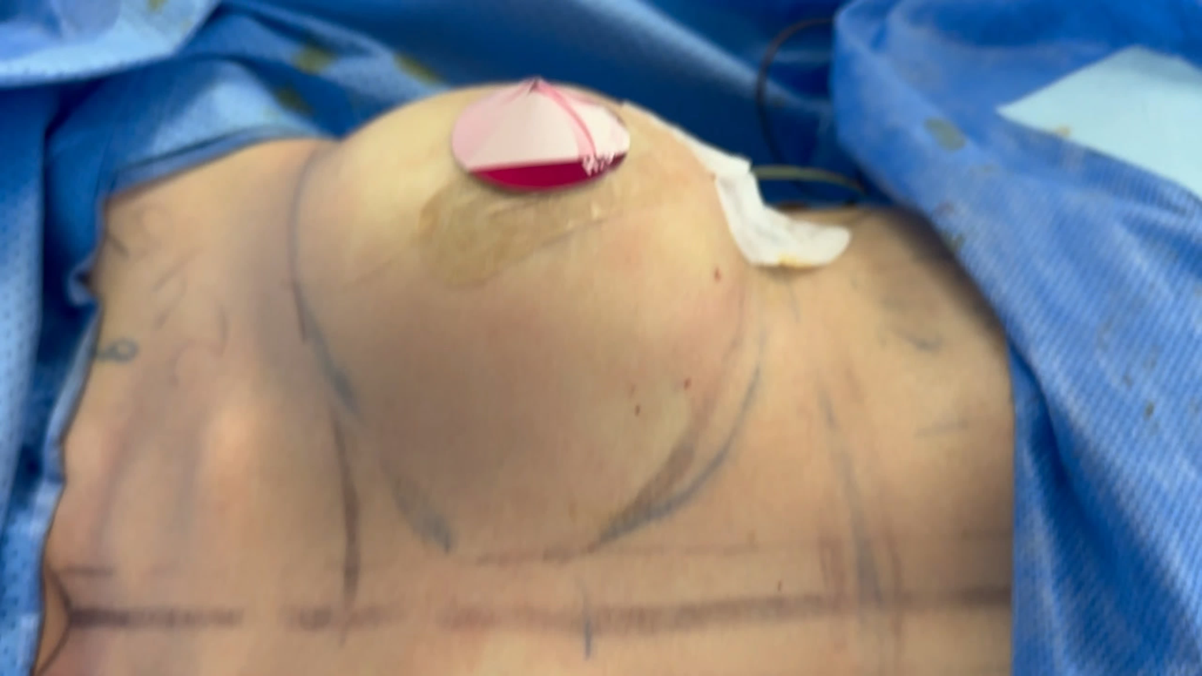 Увеличение груди анатомическими имплантатами объем 245 мл - BEST XXX TUBE