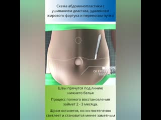 Схема проведения абдоминопластики umg клиника новосибирск