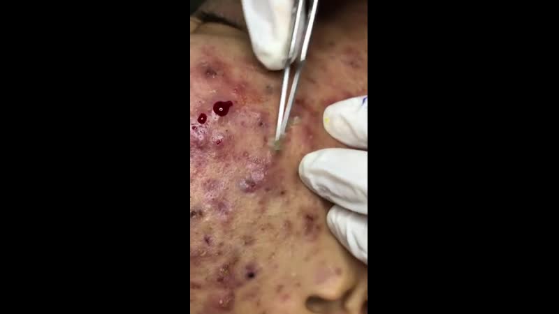 Воспаленные прыщи, корочки 3