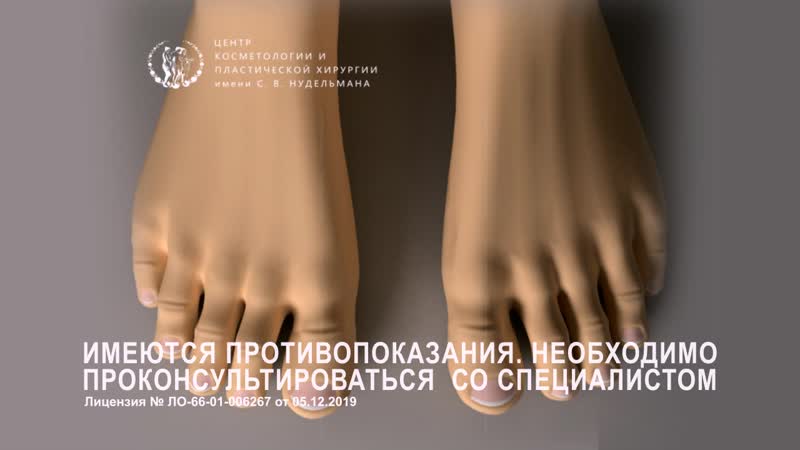 Вальгусная деформация большого пальца стопы