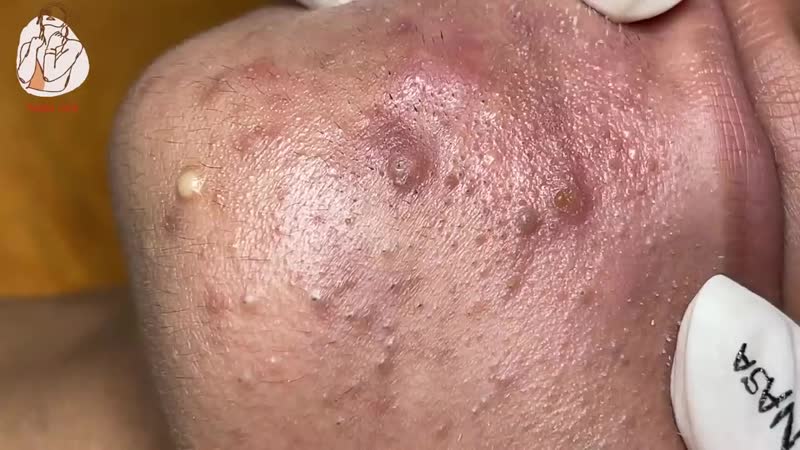 Черные точки, забитые поры