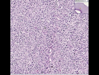 Lymph node diffuse large b cell lymphoma