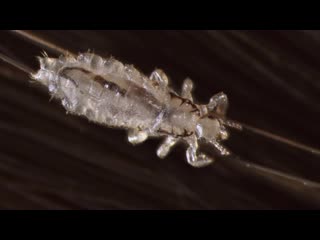 How lice turn your hair into their jungle gym (deep look)