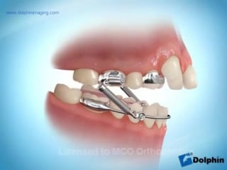 Markham, oshawa orthodontist to fix overbite higgins xbow(tm) class 2