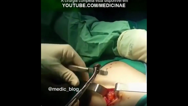 Огнестрельное ранение, извлечение пули 💉