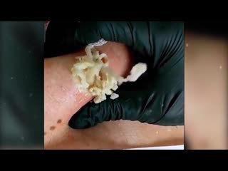 Выдавливание большой кисты