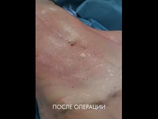 Липосакция + липофилинг ягодиц головатинский владимир