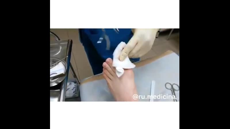 1 💉 удаление вросшего ногтя