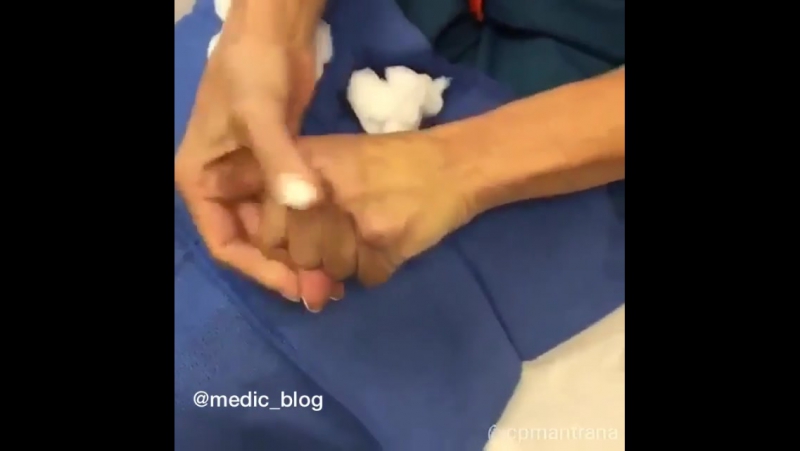 Филлер радиесс – это уникальное вещество для контурной пластики