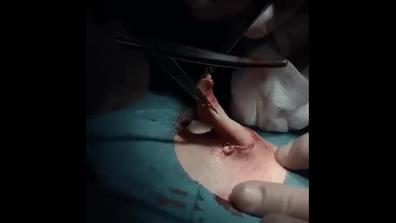 💉 удаление кисты