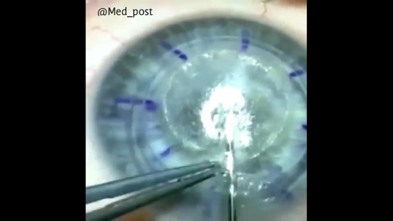 Пересадка роговицы