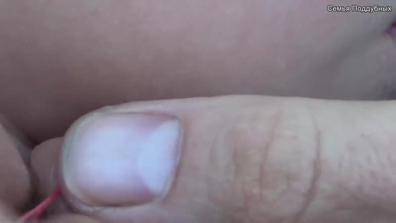 Вытащить клеща ниткой