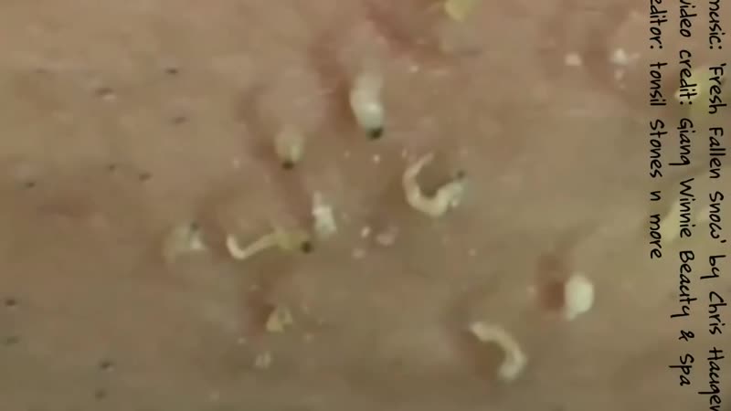 Черные точки, угри выдавливание крупно