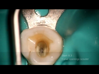 First mandibular premolar