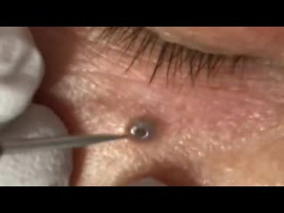 Черная точка под глазом