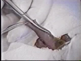 Circumcision omskaering video mpeg